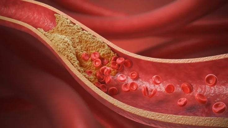 Increased Cholesterol (Rare Cases)